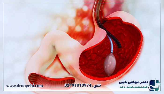نحوه انجام بوتاکس معده