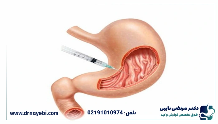 نتایج بوتاکس معده چه زمانی مشخص میشود؟