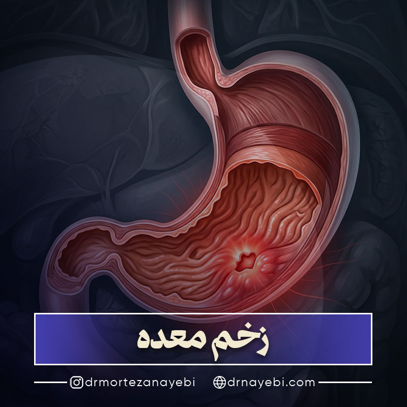 زخم معده چیست؟