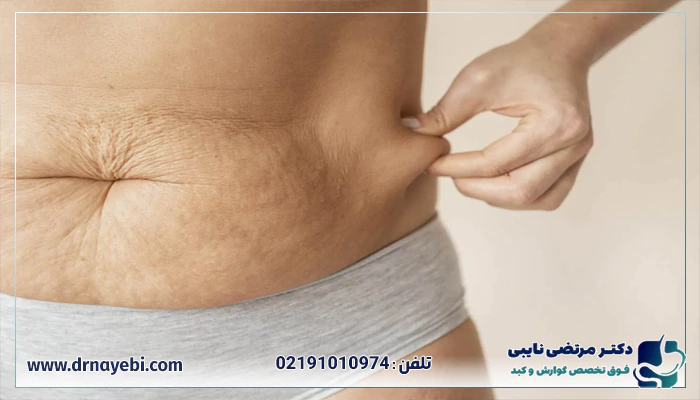 احتمال بازگشت وزن بعد از بوتاکس معده چقدر است؟
