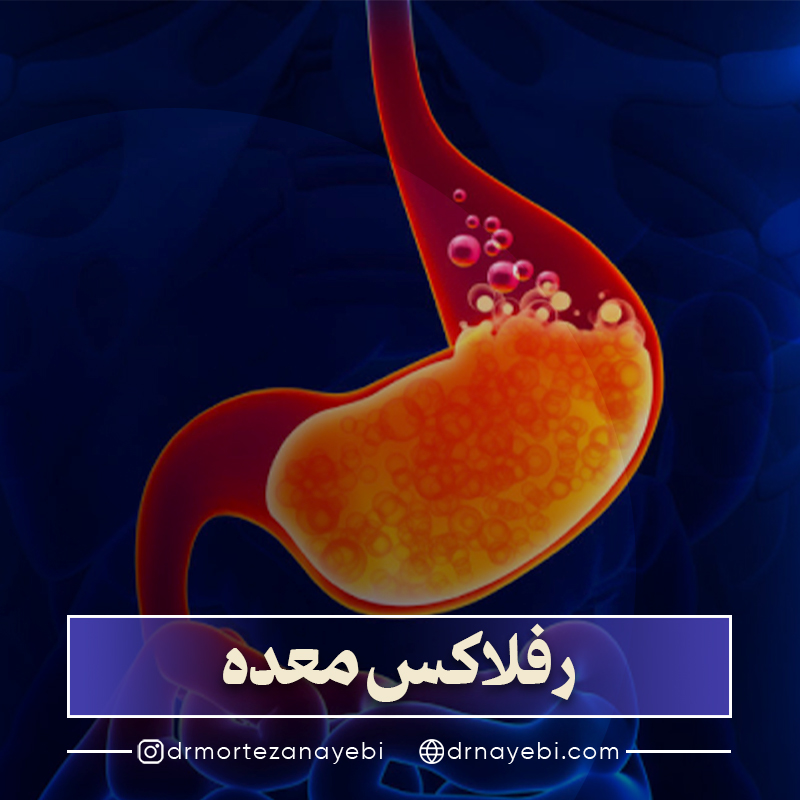رفلاکس معده