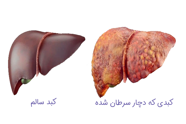 مقایسه کبد سالم با کبد دچار سرطان