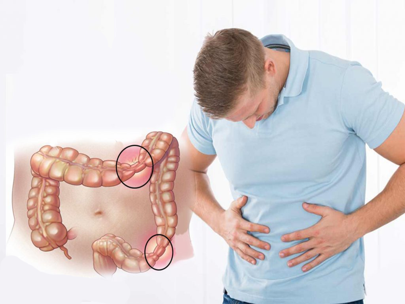 درباره سندرم روده تحریک پذیر