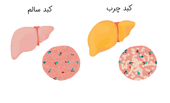تفاوت کبد سالم و چرب