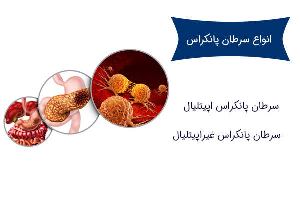 انواع سرطان پانکراس