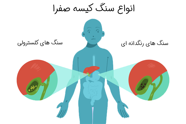 انواع سنگ کیسه صفرا