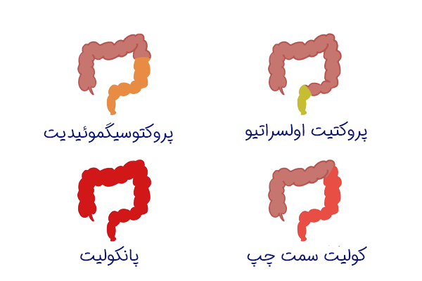 انواع کولیت روده