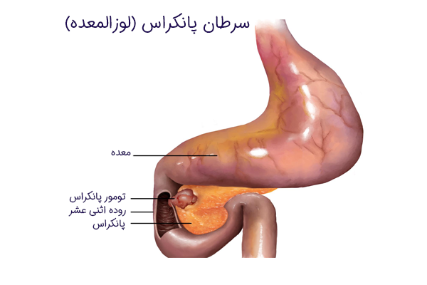 سرطان پانکراس