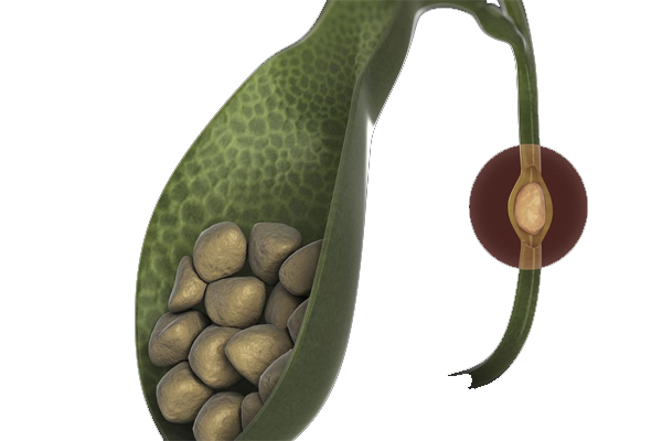 سنگ کیسه صفرا