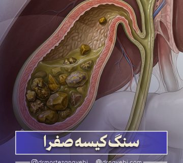 سنگ کیسه صفرا چیست و چگونه درمان می شود؟