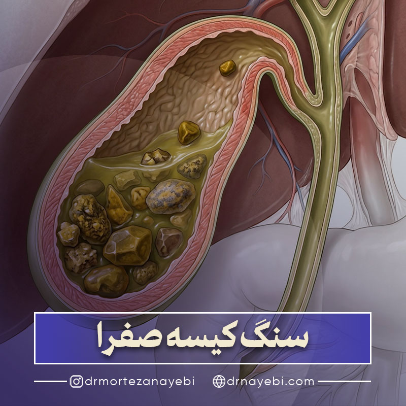 سنگ کیسه صفرا چیست و چگونه درمان می شود؟