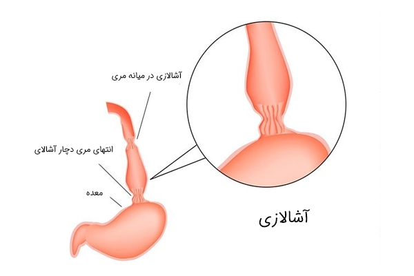 بیماری آشالازی
