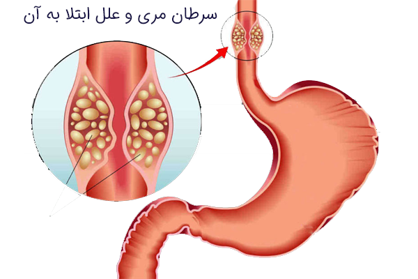سرطان مری و علل ابتلا به آن
