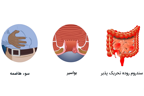 علائم سرطان روده بزرگ1