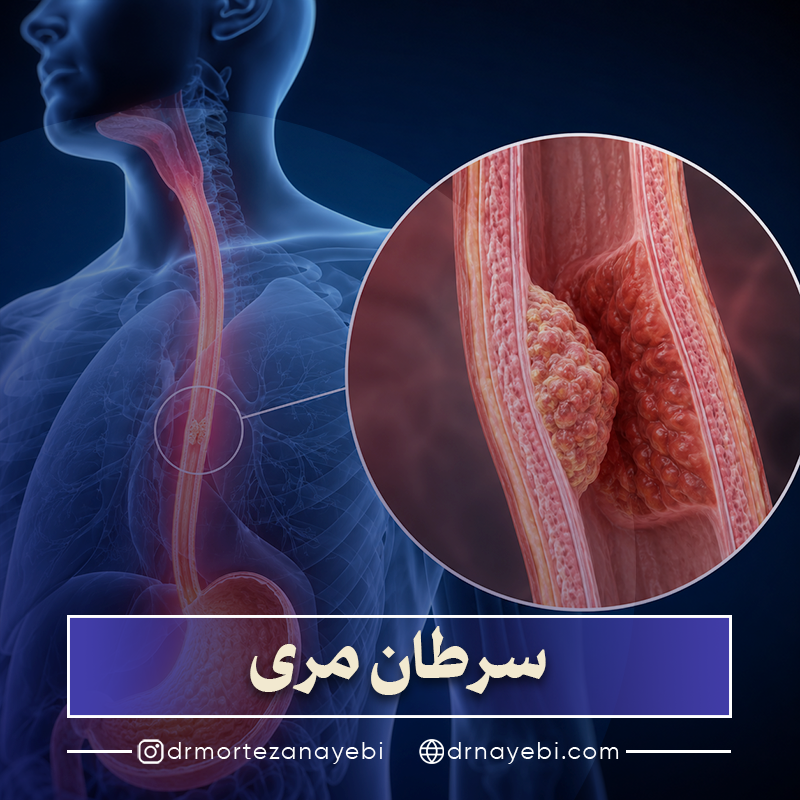 سرطان مری چیست؟