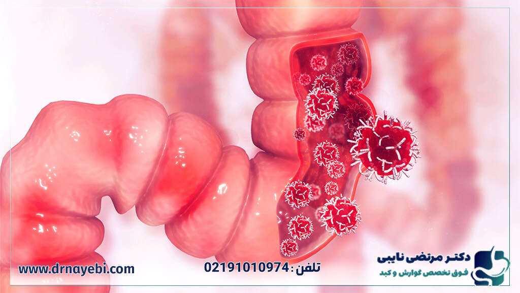 هزینه انواع روشهای کولونوسکوپی