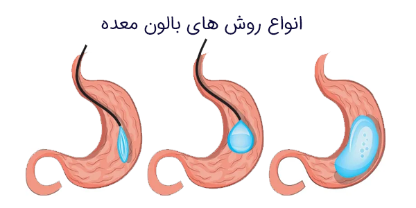 انواع روش های بالون معده