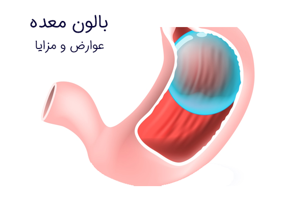 بالون معده (عوارض و مزایا)