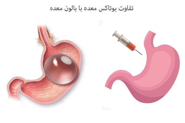 تفاوت بوتاکس معده با بالون معده