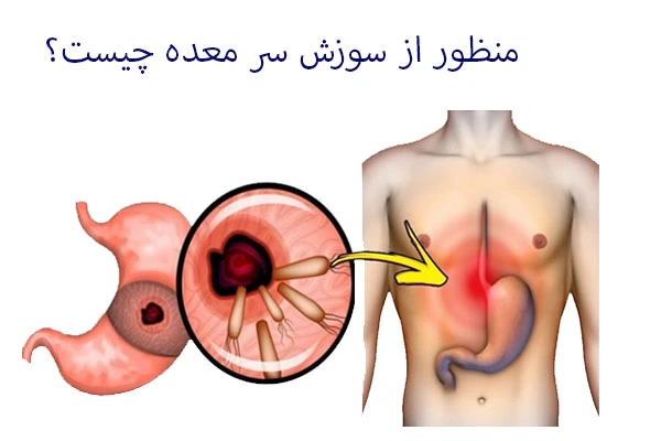 منظور از سوزش سر معده چیست؟