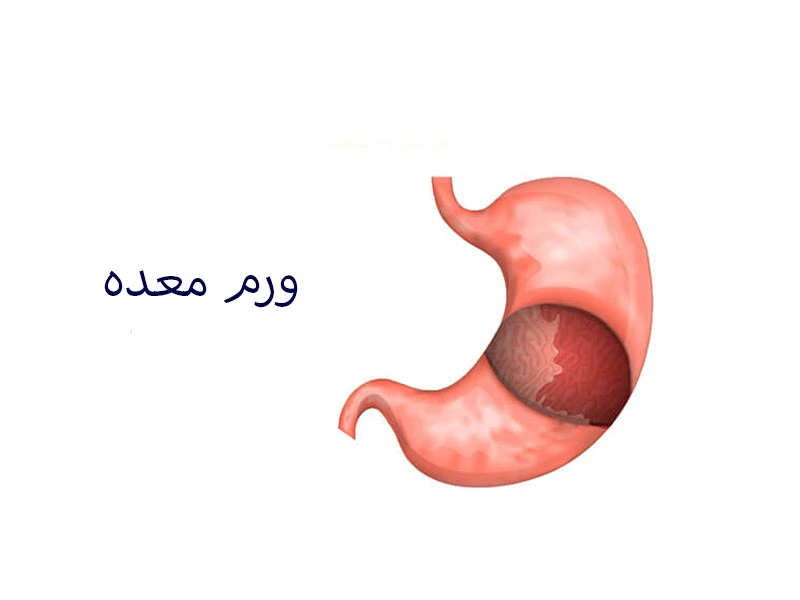 درباره ورم معده