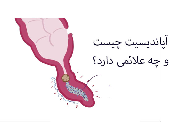 آپاندیسیت
