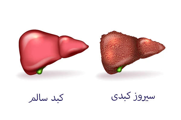 تفاوت کبد سالم با سیروز کبدی