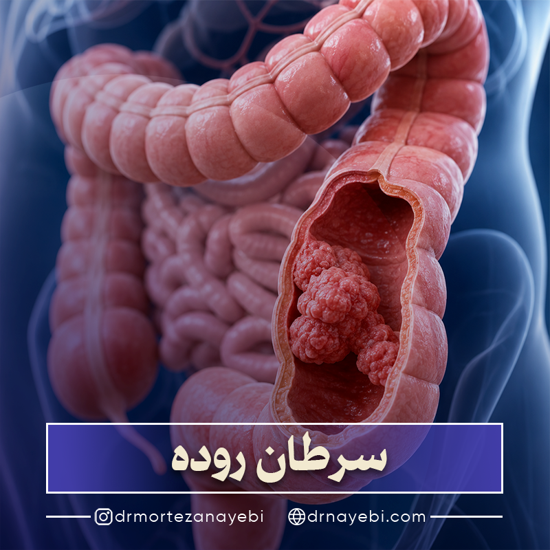سرطان روده چیست؟