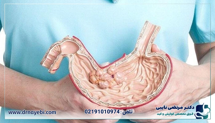 بوتاکس معده در تهران چگونه انجام می‌گیرد؟