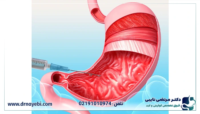 رژیم غذایی بعد از بوتاکس معده برای لاغری