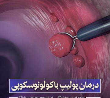درمان پولیپ روده در حین کولونوسکوپی
