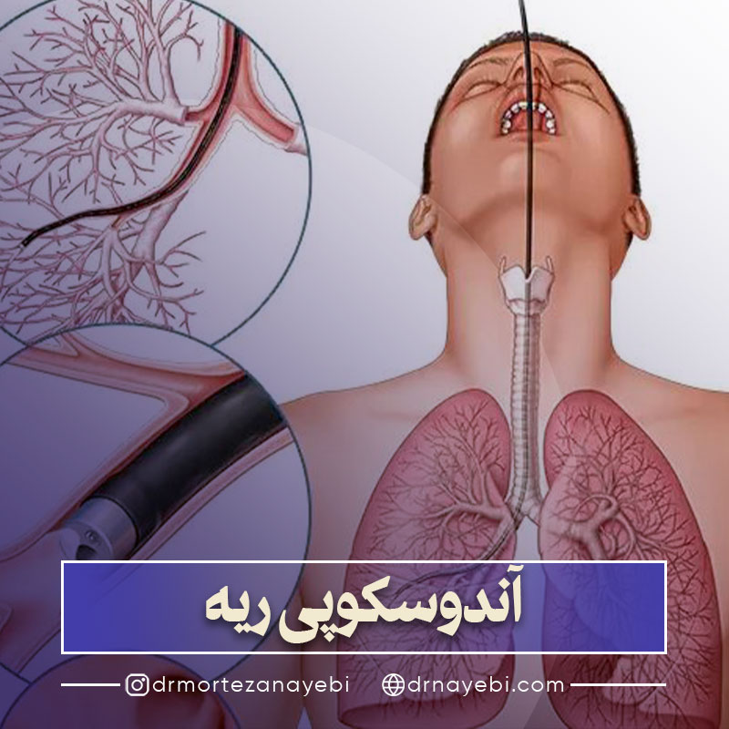 آندوسکوپی ریه