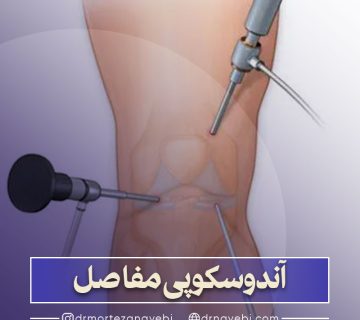 آندوسکوپی مفاصل