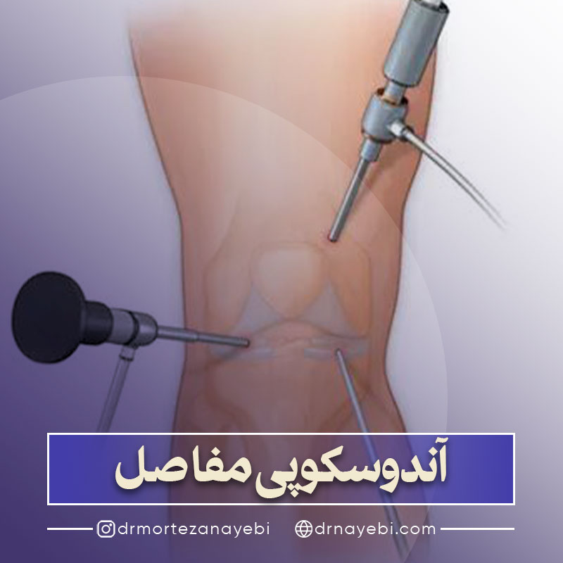آندوسکوپی مفاصل