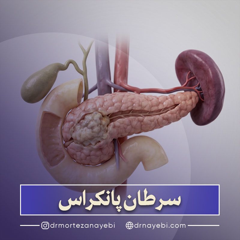 سرطان پانکراس (لوزالمعده)